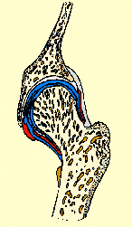 EROSION OF CALCIUM in BONE KNOBS =
                    HUGE PAIN, arthritis cure is, do not erode
                    wi.diuretics