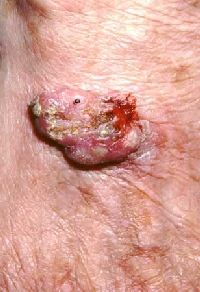 squamous skin cancer, actual photo