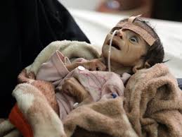 starving baby in yemen, torn by civil
                        war, saudis are bombing it daily with our jets,
                        bombs. WE SUPPLY SAUDI ARRABIA so they can kick
                        the #$*&% out of this tiny, impoverished
                        country. GO FIGURE!